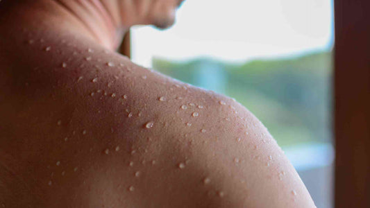 Is Infrared Sauna Good for Eczema?